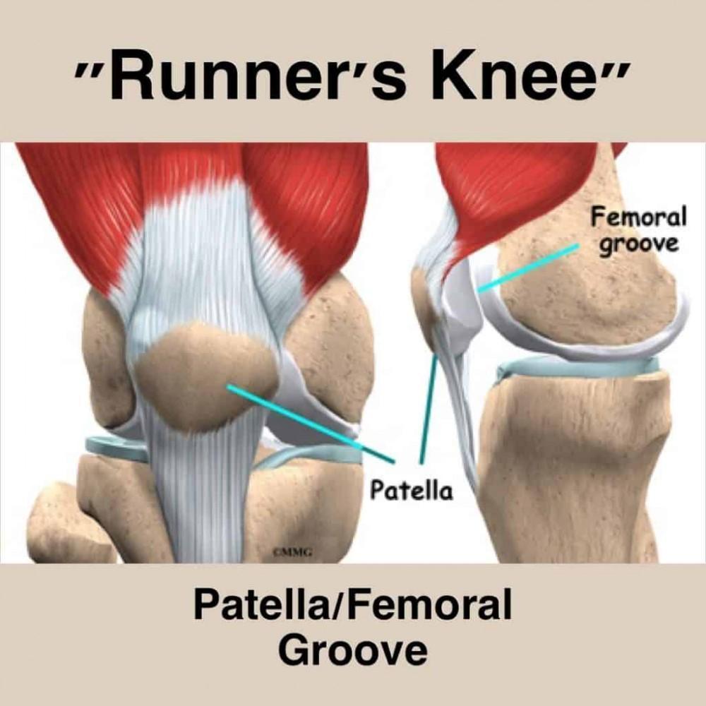 Patellofemoral Syndrome Relief for Knee Pain